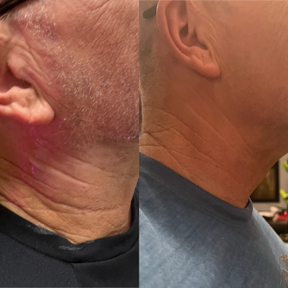 Biostimulator Skin tightening