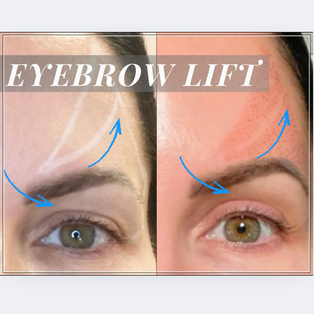 Eyebrow Lift