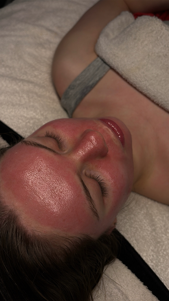 Lizards Microneedling🫧