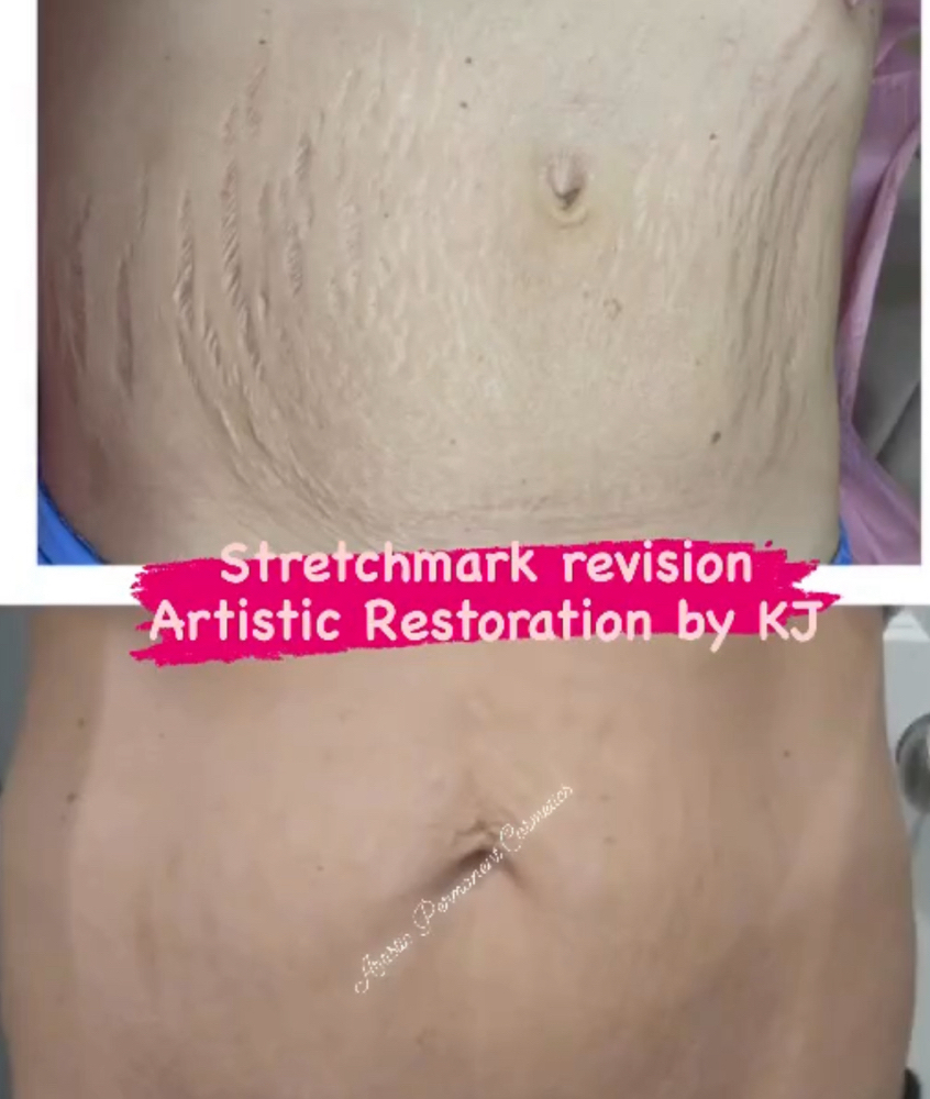 Stretch-mark Inkless Healing