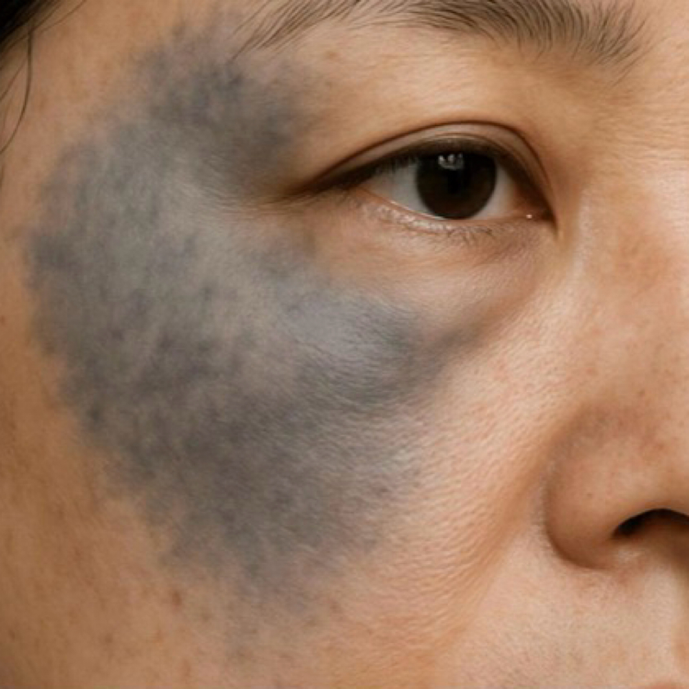 Nevus Of Ota (3) at La Belle Studio by Soraya in Woburn, MA