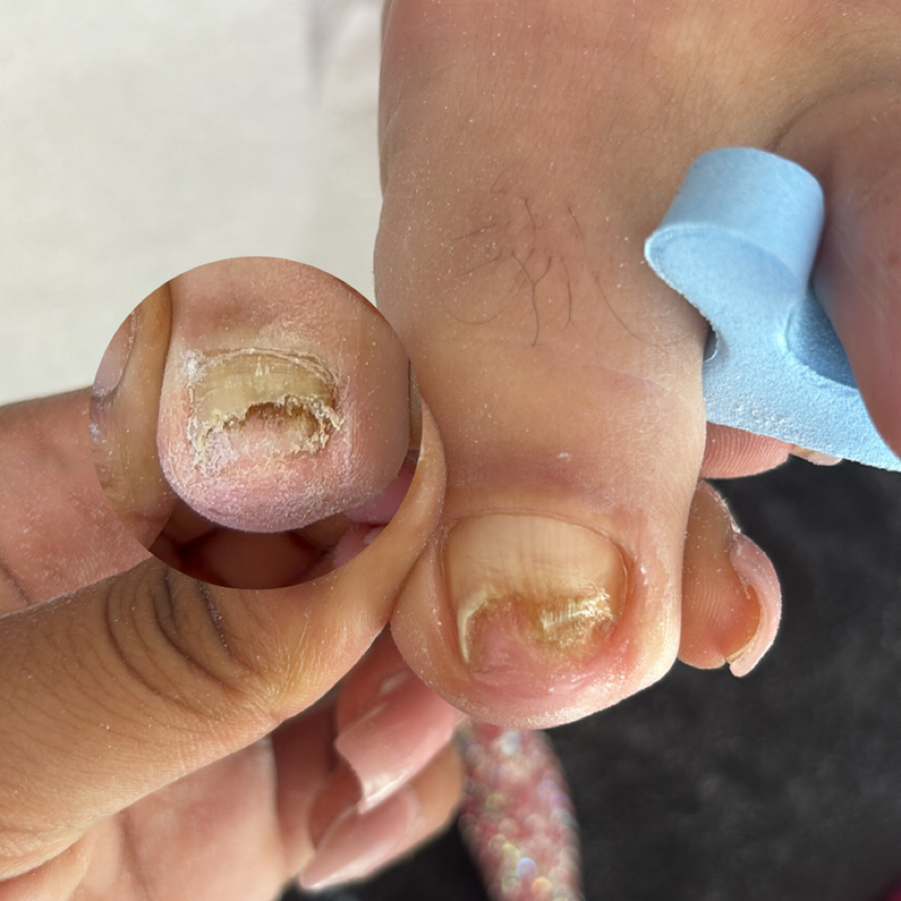 Light Fungus + Treatment W Acrylic at LuxBeautyLab in Kissimmee, FL