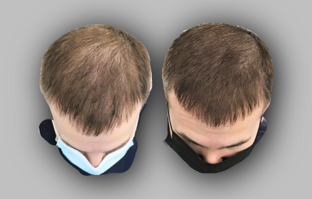 Mens Hair Density (Front Hairline)