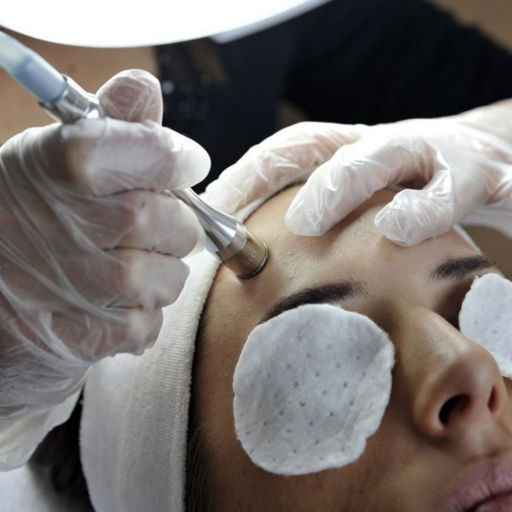 Lux Microdermabrasion Facial at ULTRA LUX MED SPA in Myrtle Beach, SC