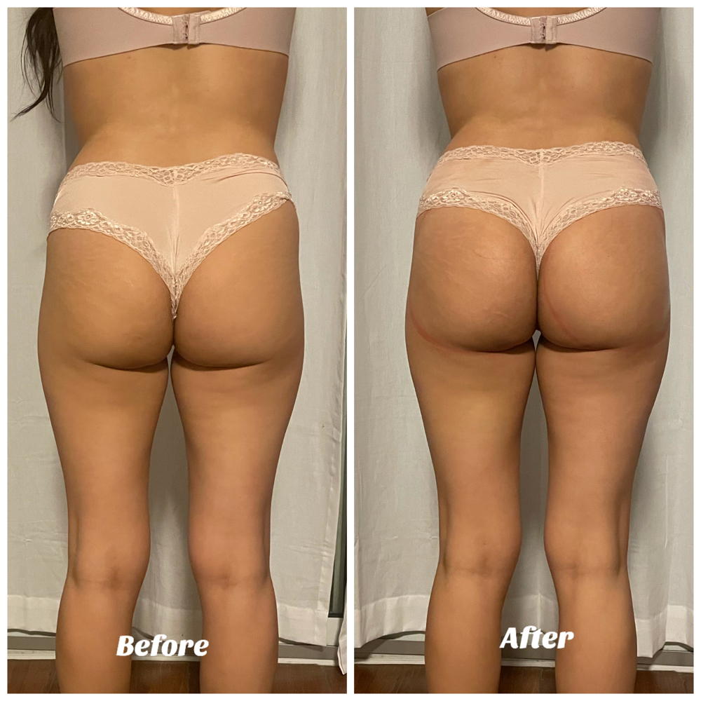 Non-invasive BBL