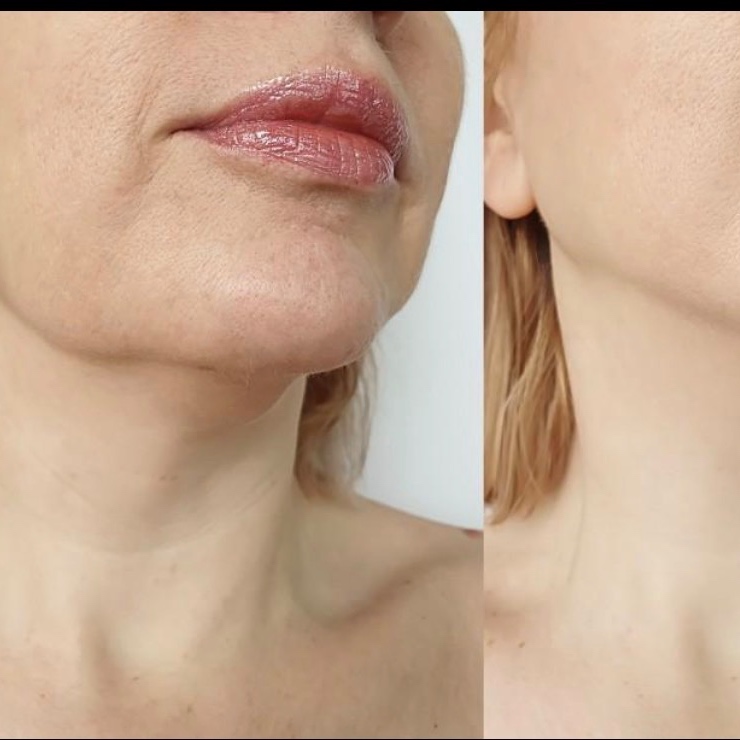 Jowls at Radiant Aesthetics by Liz in El Paso, TX