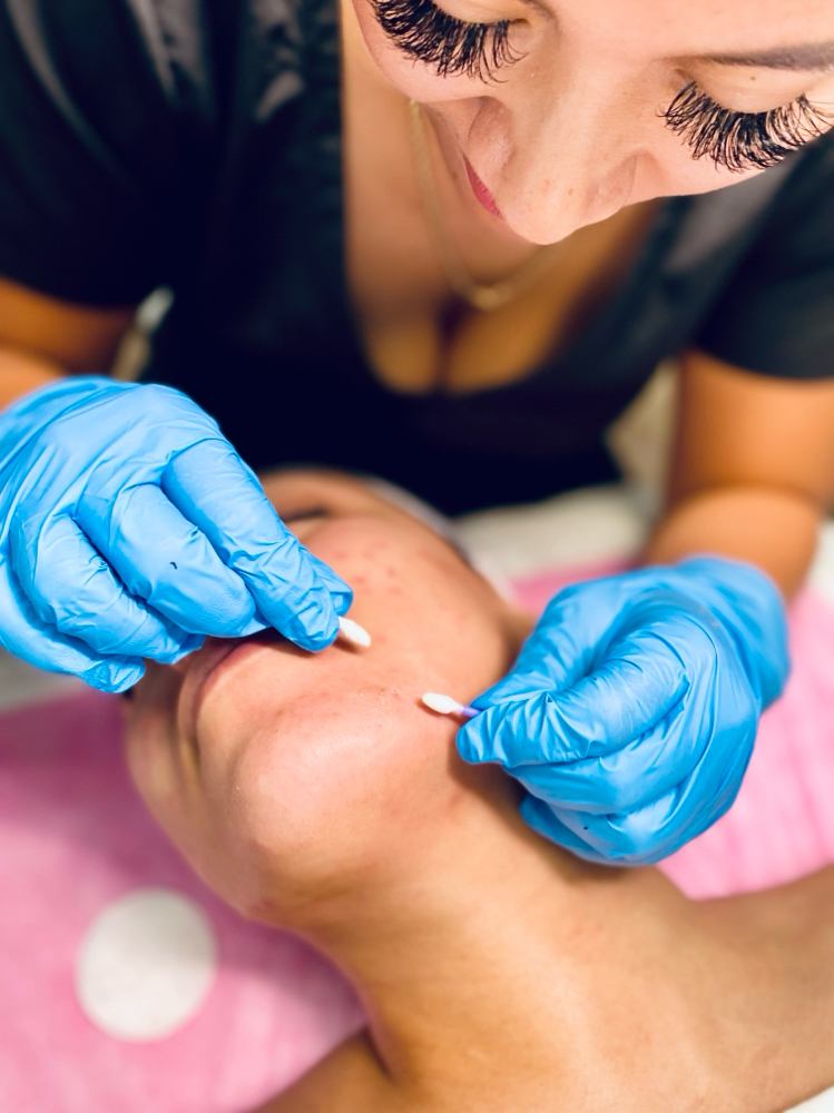 Acne Facial