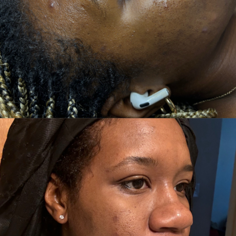 Clear Skin Boot Camp (In-Person)F/U