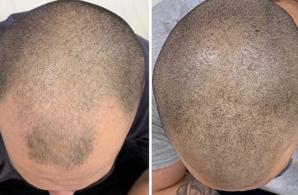 Scalp Micropigmentation