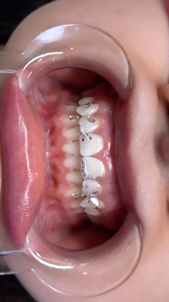 1:1 Tooth Gem Course