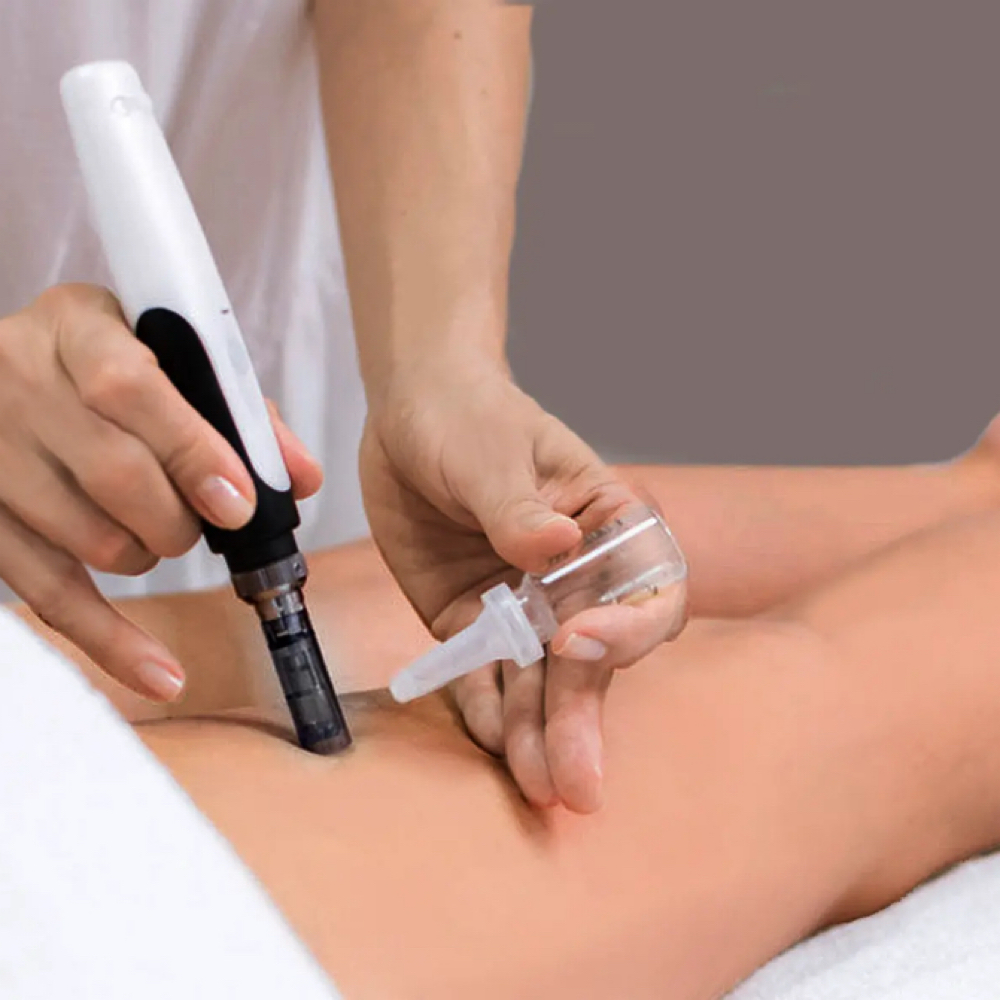 Scar And Stretchmark Microneedling at Kizmet Beauty in Vero Beach, FL