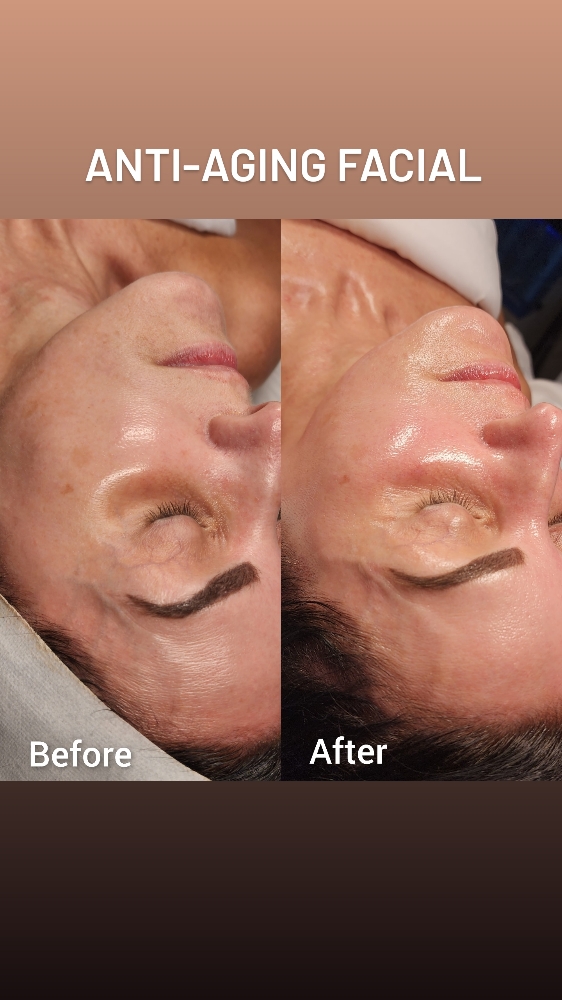 Ante-Age Stem Cell Facial