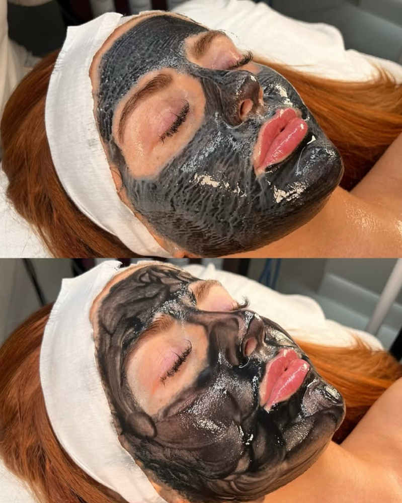 Acne Heal facial