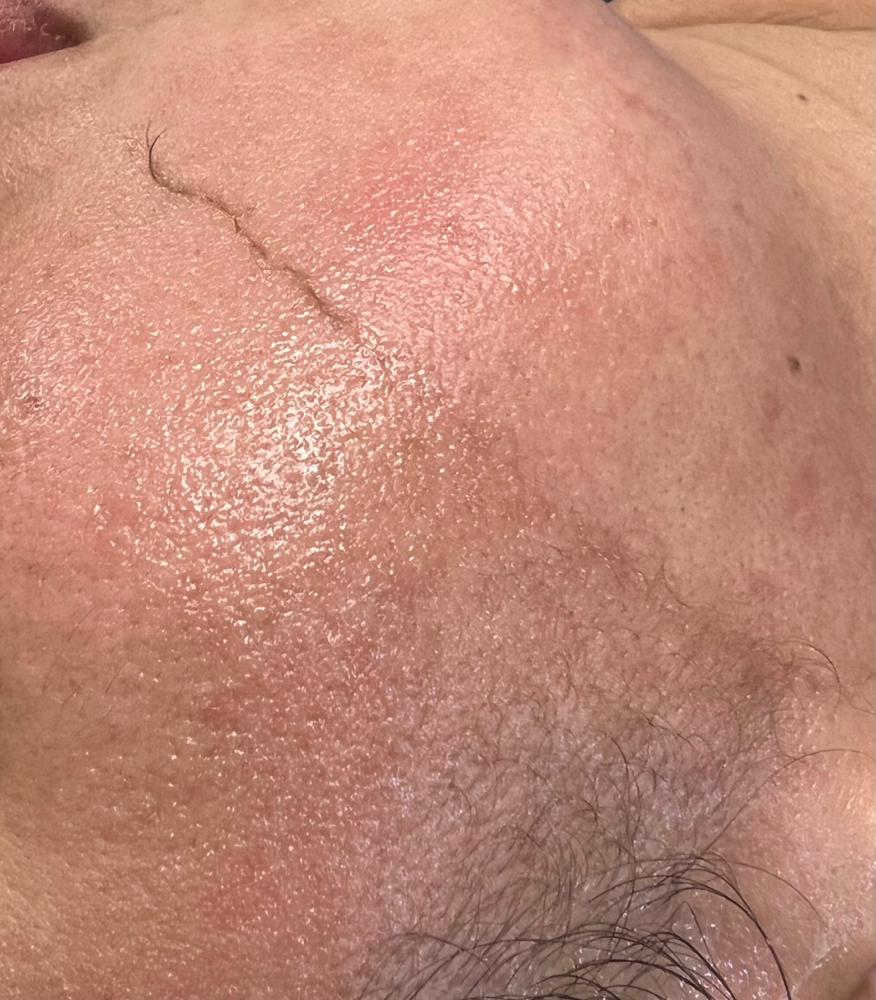 Dermaplane Facial