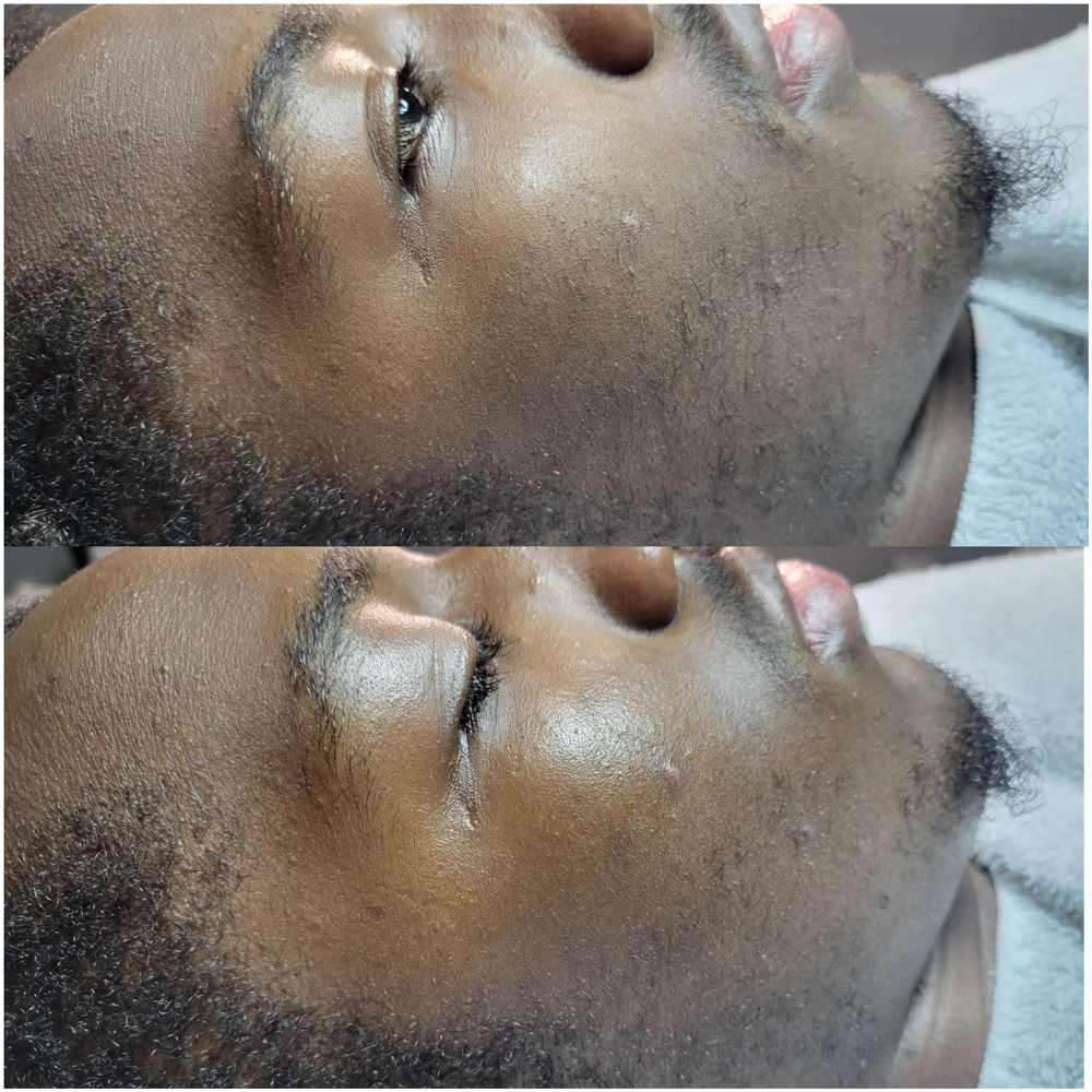 90min. Deep Treatment Facial