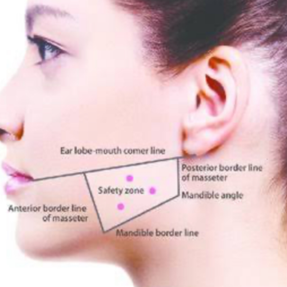 Master Bruxism (Tox Jawl Contour) at Finesse Sculpt Body Studio in Parkville, MD