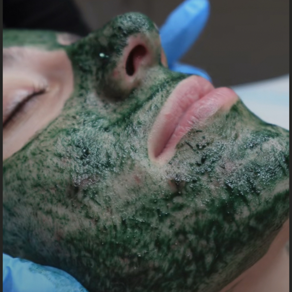 Green Sea Peel at Verre Skin in Pembroke Pines, FL