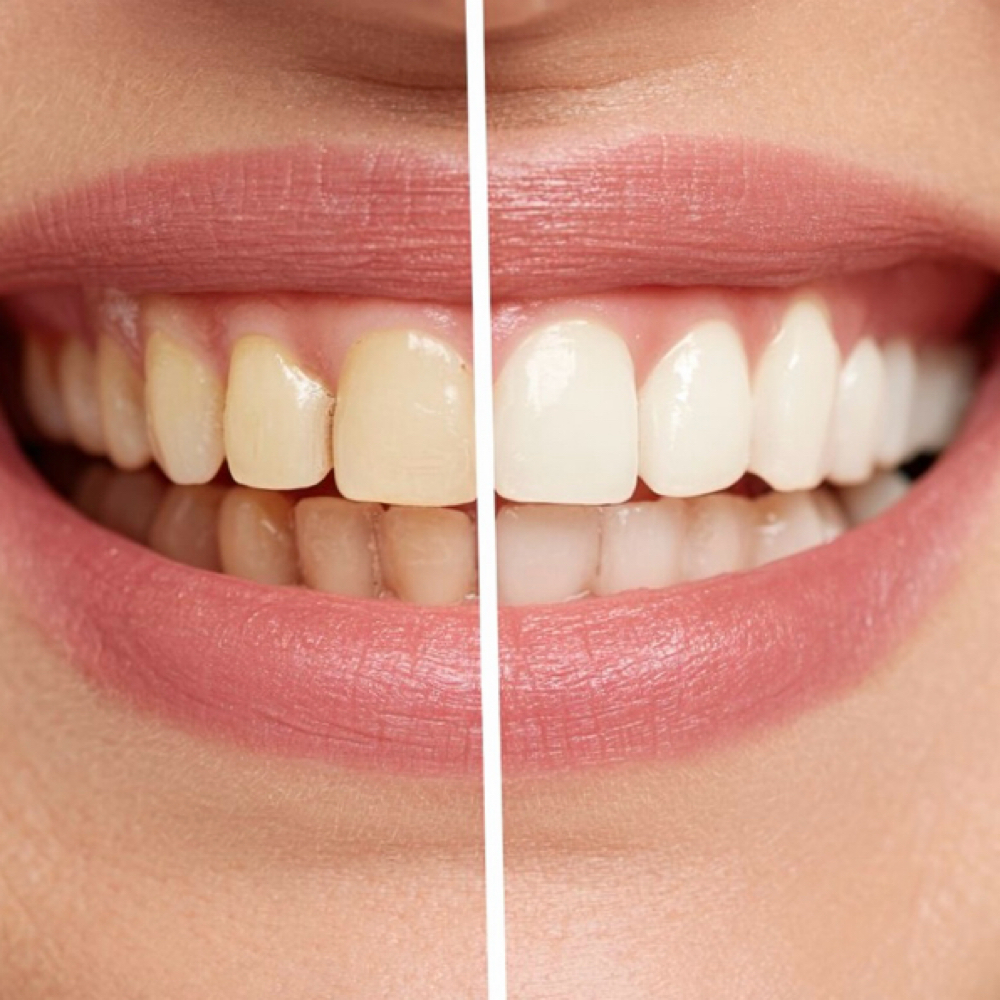 Teeth Whitening at Tara Tilley Beauty in Winston Salem, NC