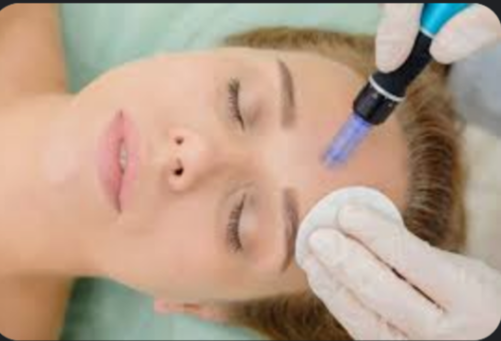 1 Microneedling area/session