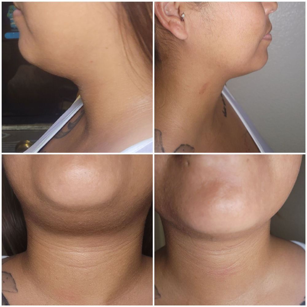 Chin sculpting 3 sessions