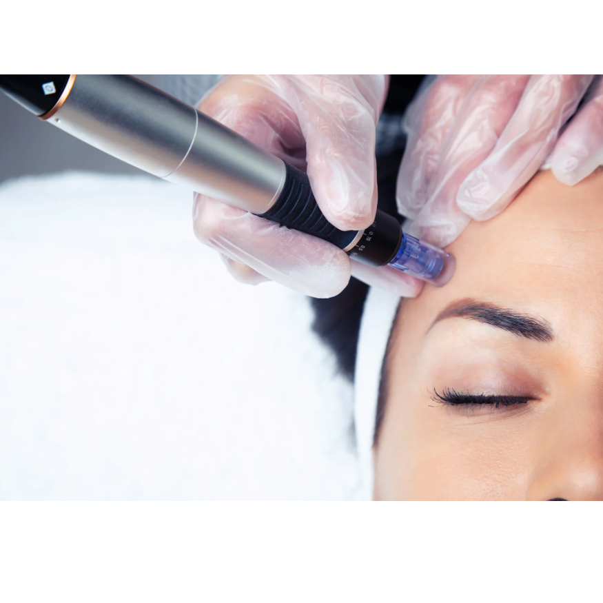 Microneedling at Luxe Lines and Lips, PLLC in Halls, TN