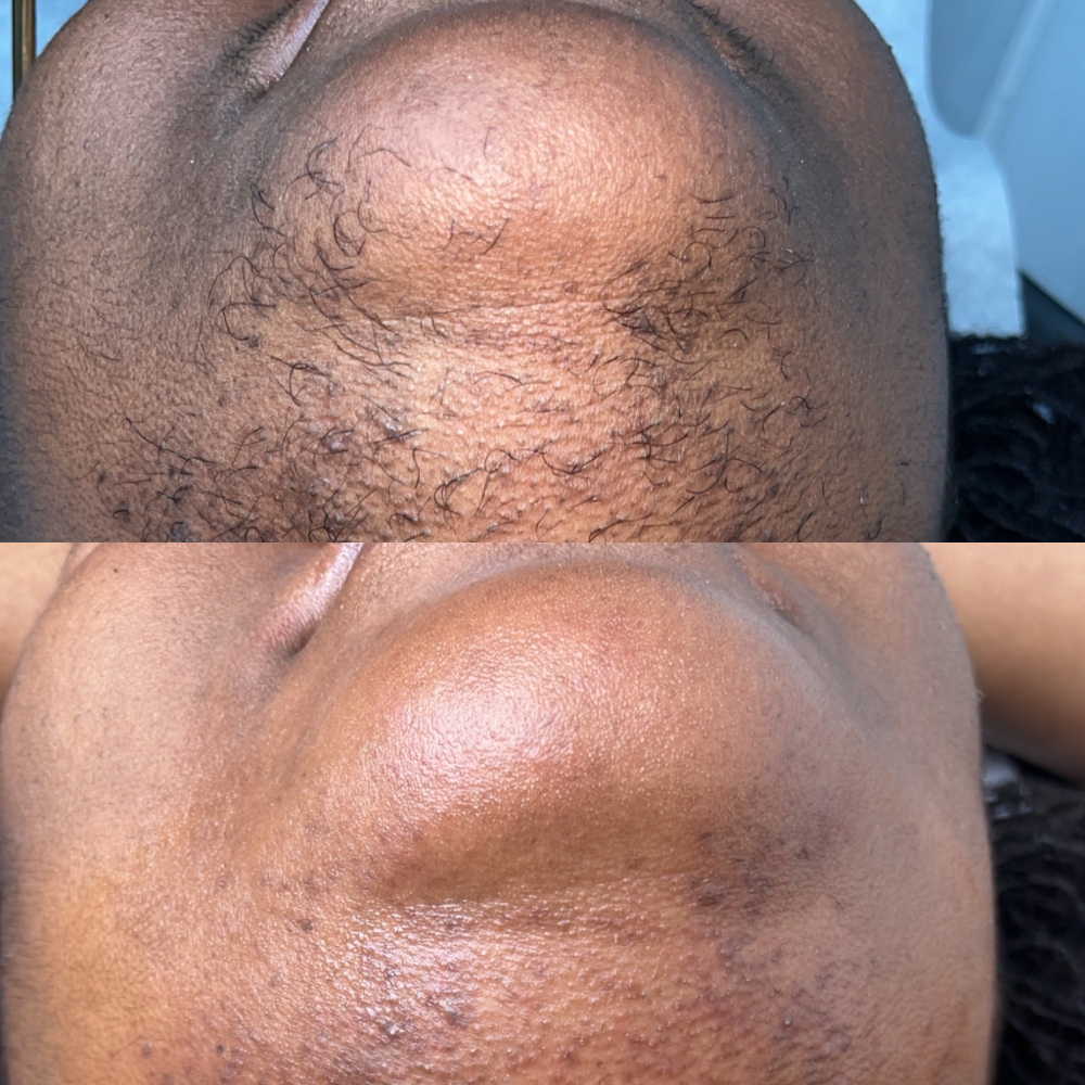 Chin Wax