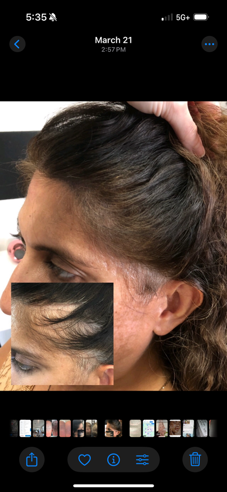 Scalp Micropigmentation