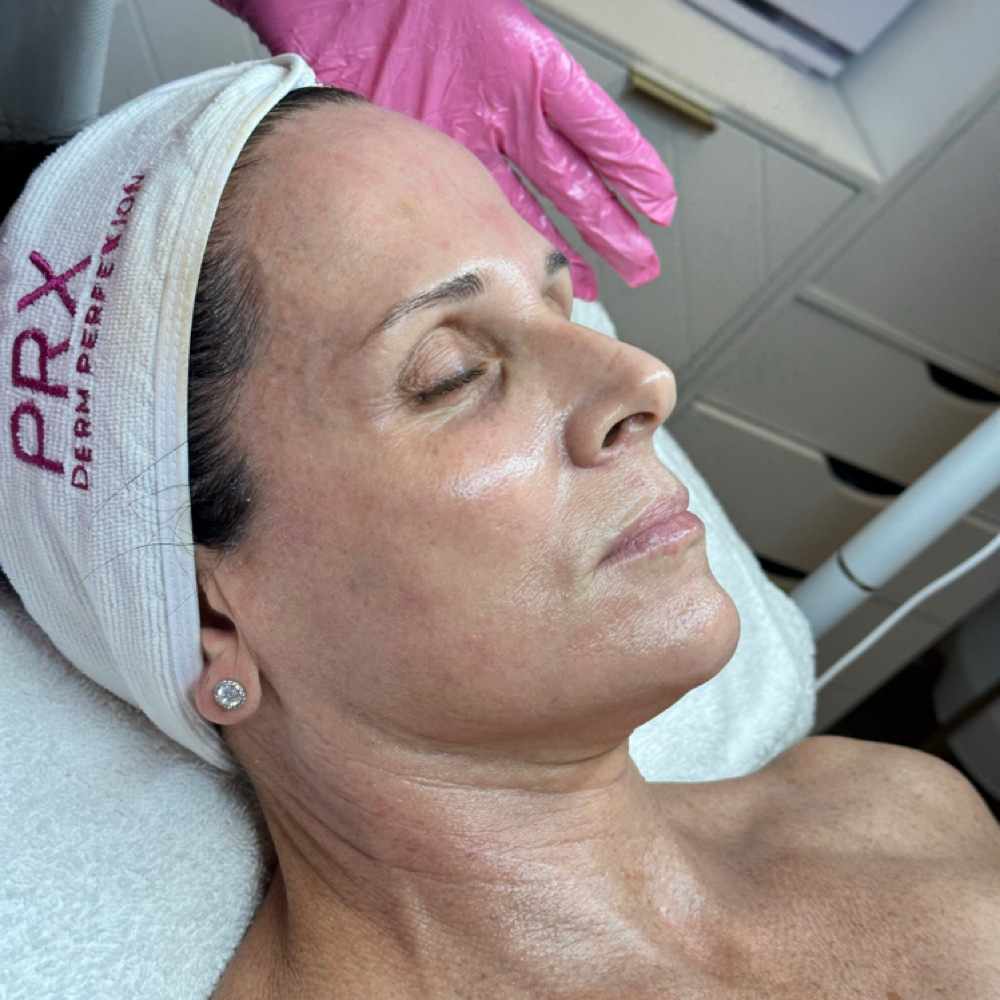 PRX-C Treatment at Skyn Esthetics INC. in Boca Raton, FL