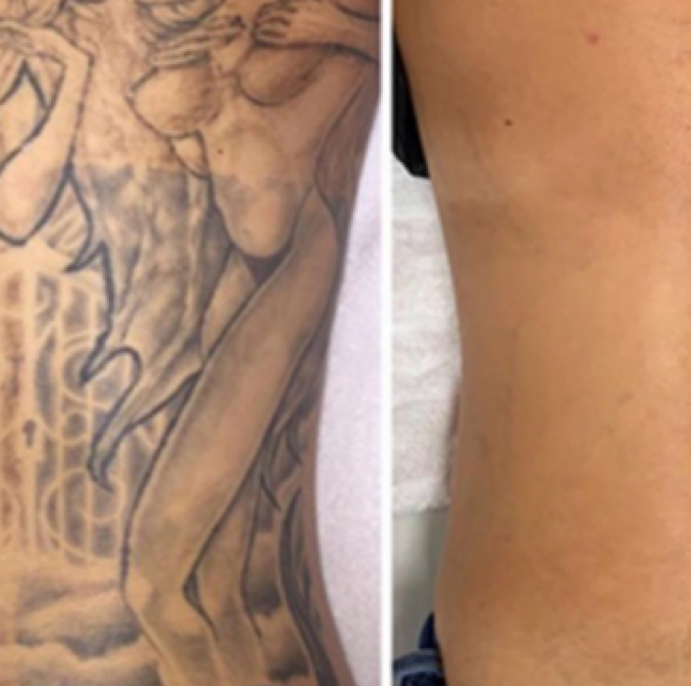 Tattoo Removal XL - Unlimited at NICHÉ in Lewisville, TX
