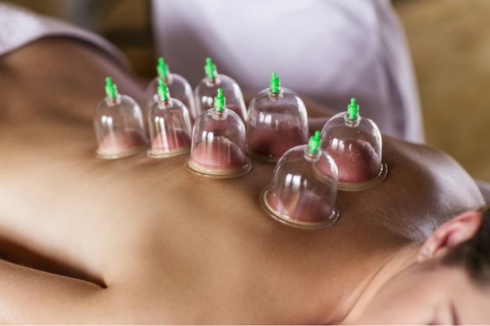 Therapeutic Cupping Therapy