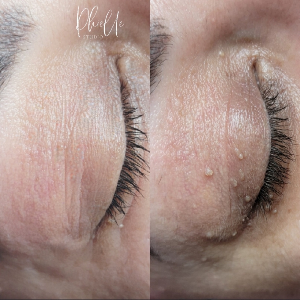 Skin Tag Removal 20each