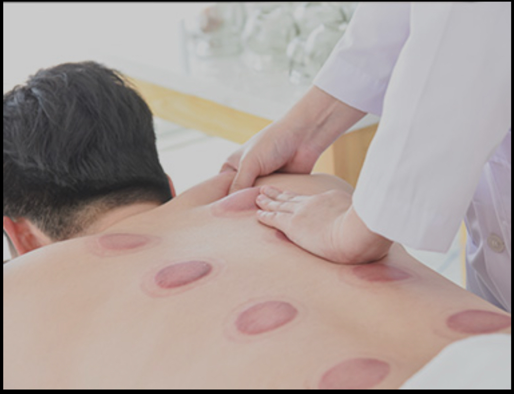 Tui Na & Cupping Therapy Combo