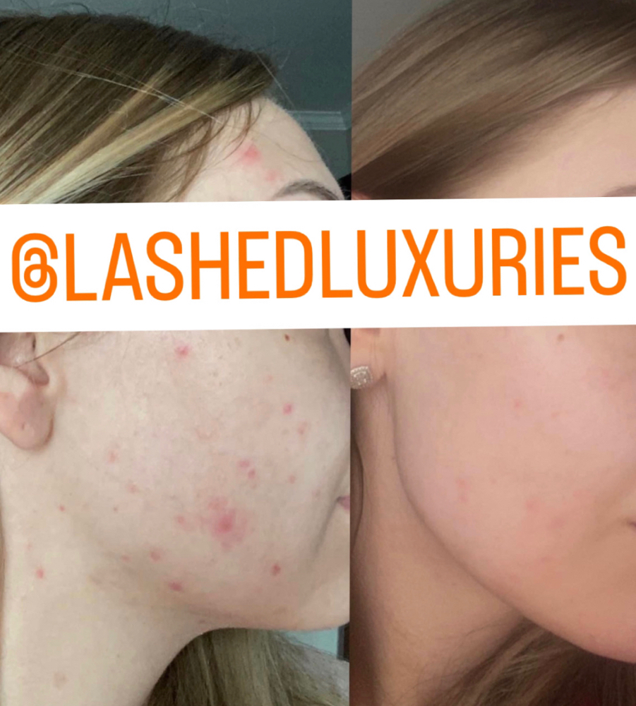 Customized Acne Treatment