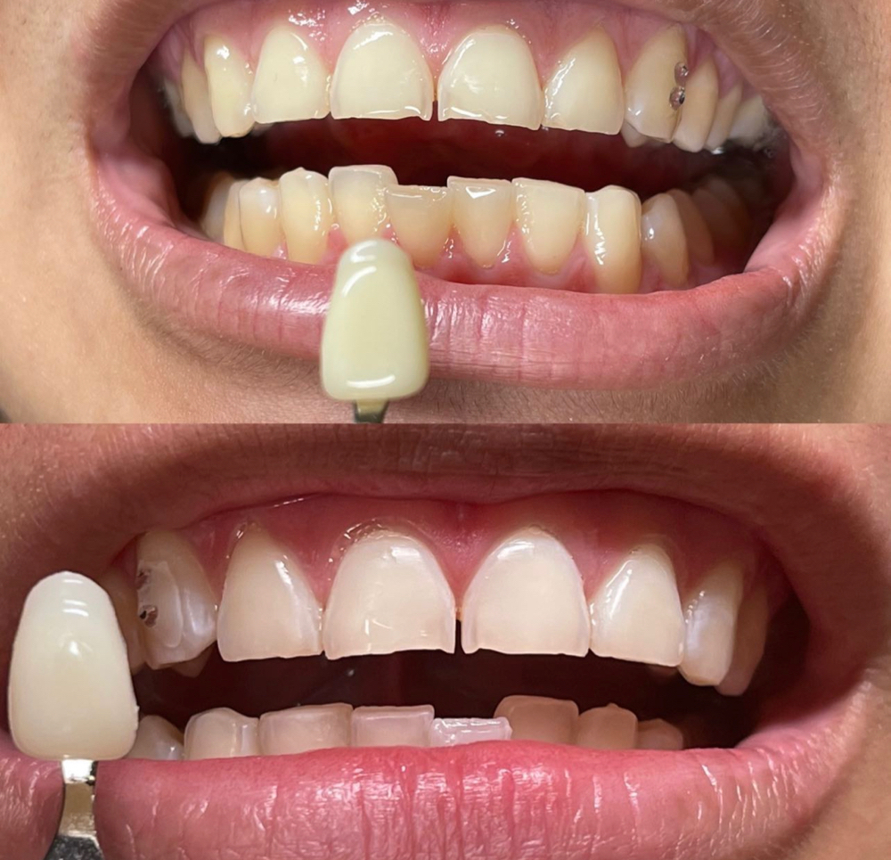80 Min Teeth Whitening Session