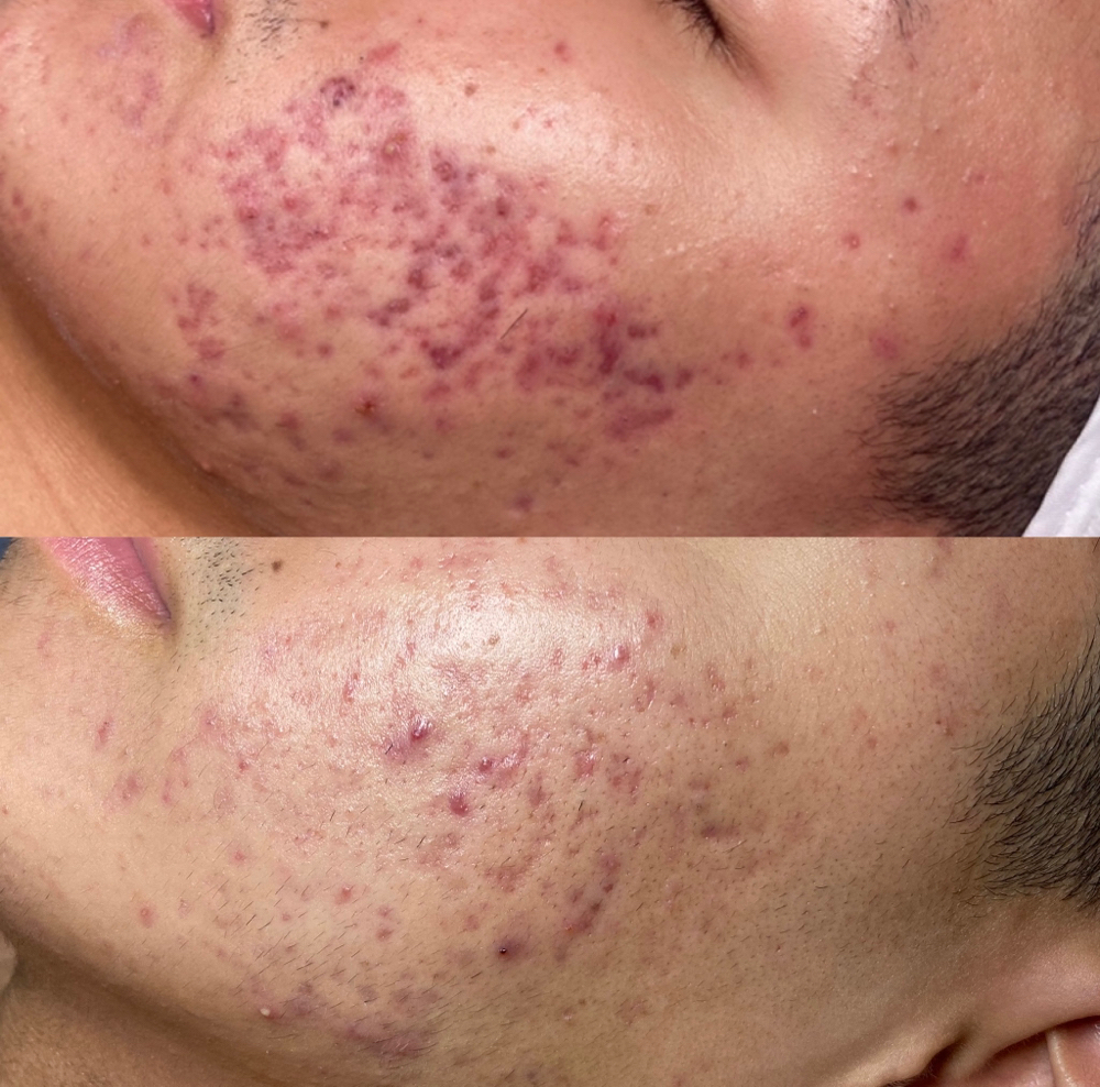 Acne Treatment