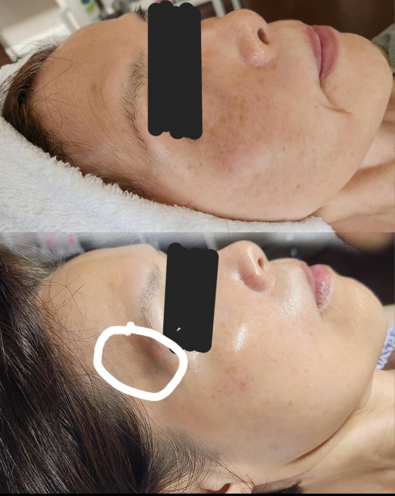 Microcurrent Facial