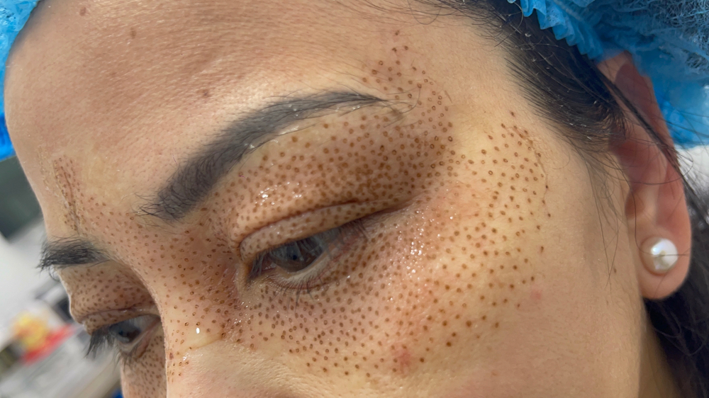 Upper Eyelids Treatment By Plasma