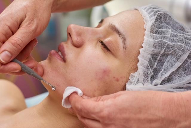 Acne Treatment Facial