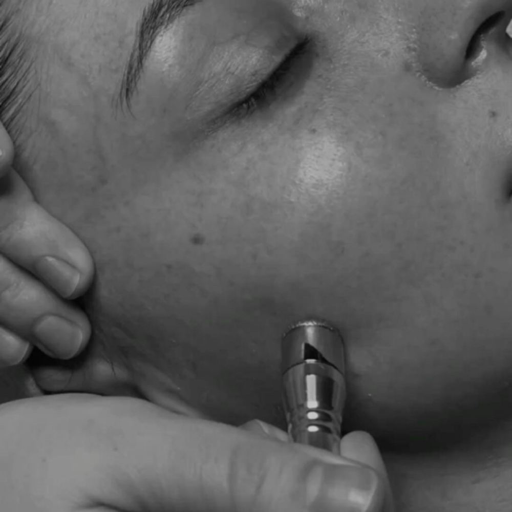 Microdermabrasion Facial at Summer Time Skin in West Plains, MO