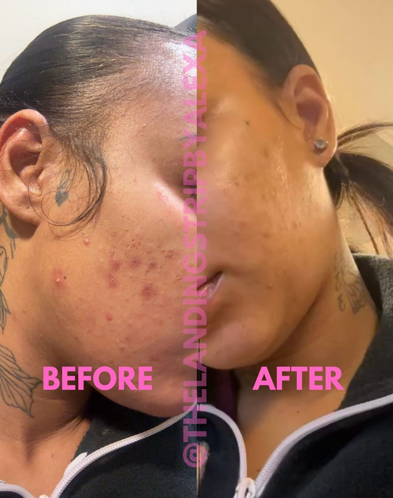 MandeliClear Chemical Peel