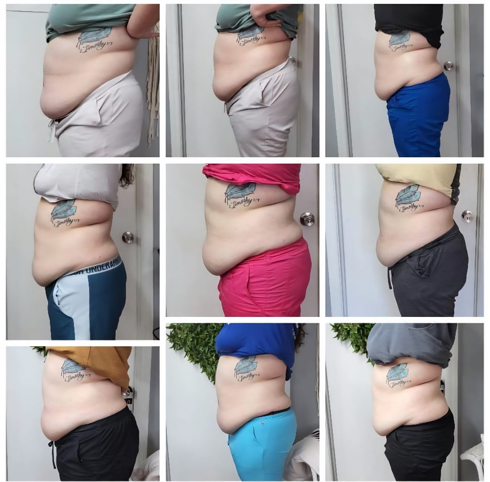 4d Lipo &Skin Tightening 2 Spots