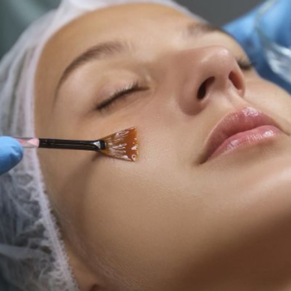 TCA Chemical Peel at Shannon’s Skincare Studio in Clemmons, NC