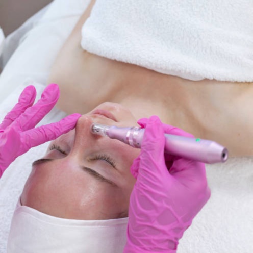Microdermabrasion Facial