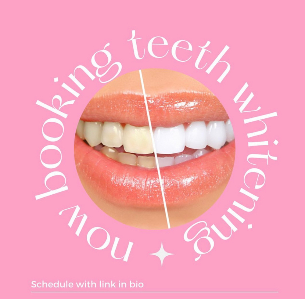 Teeth Whitening