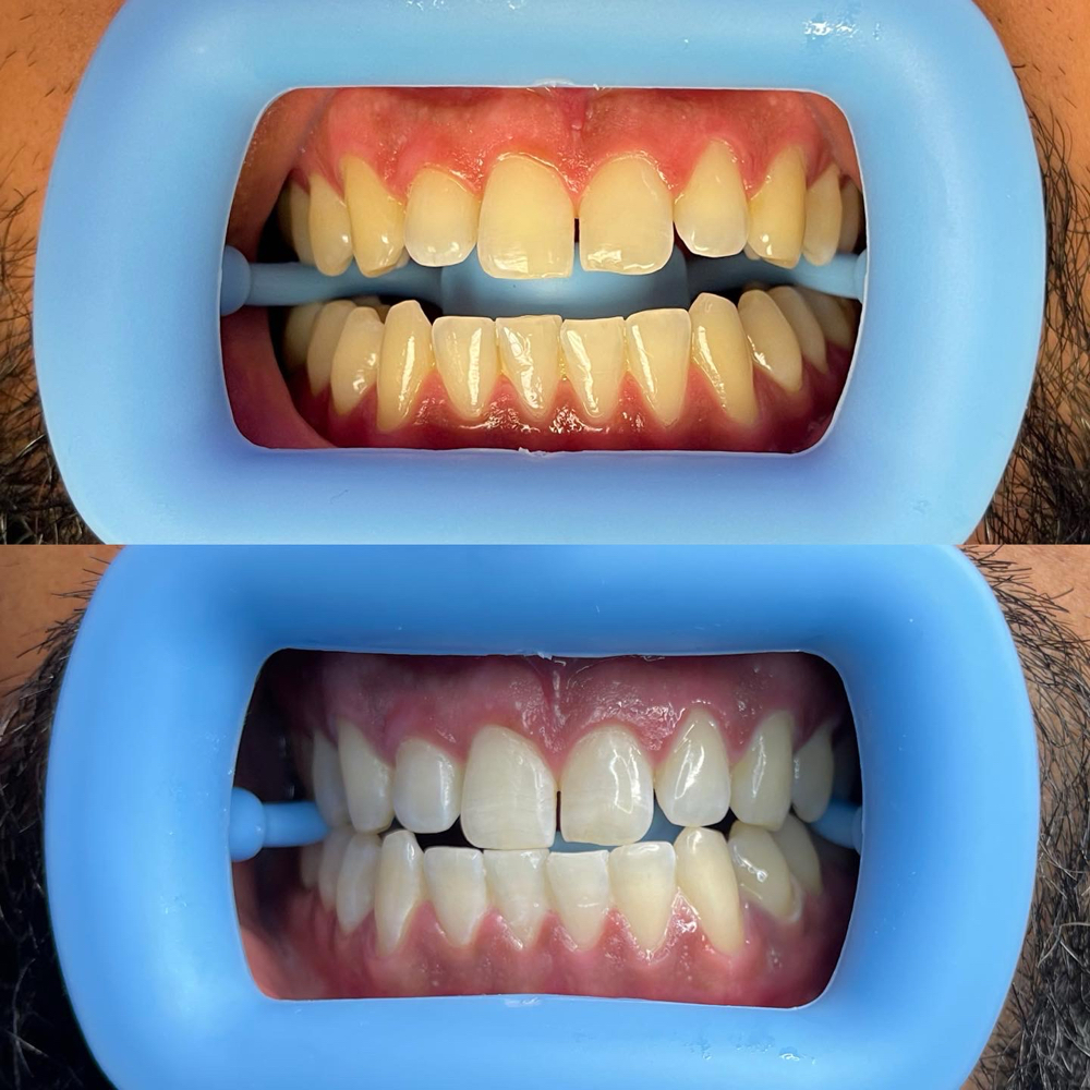 Cosmetic Teeth Whitening (Touch Up)
