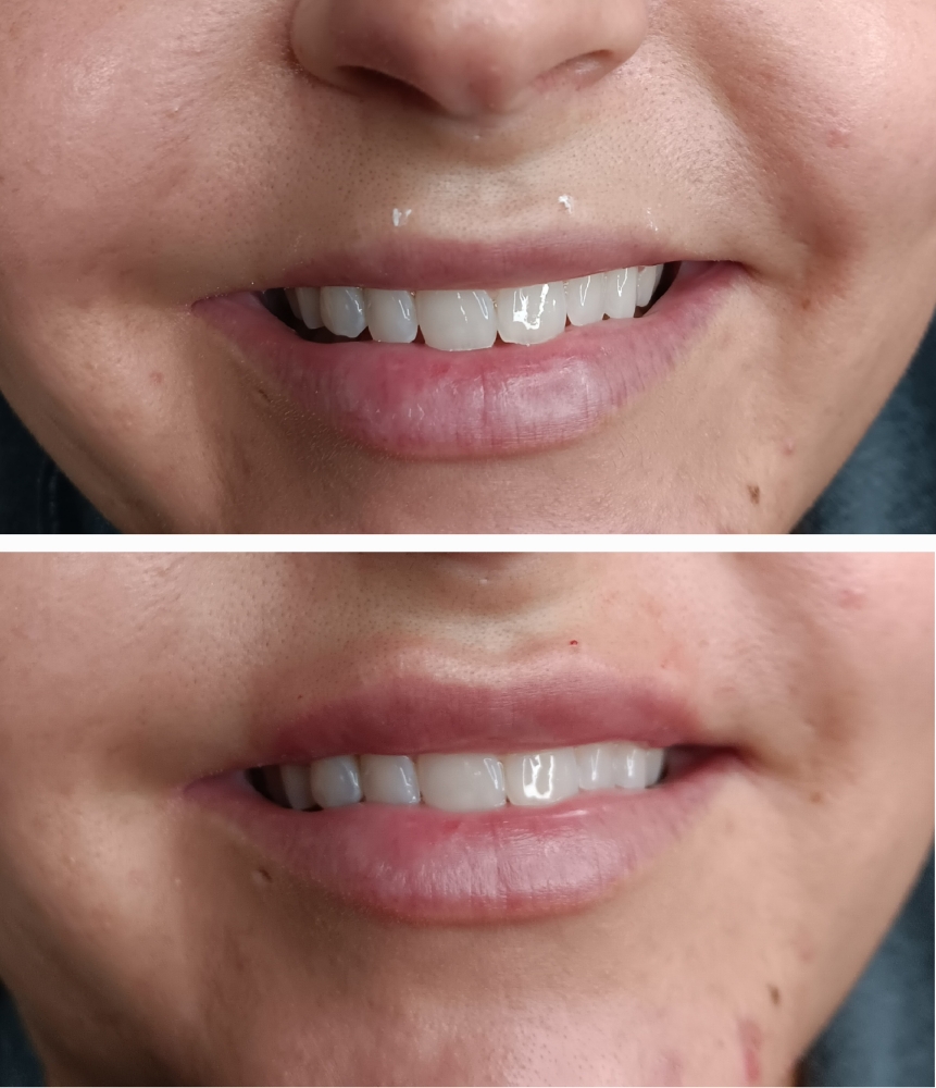 Lip Flip (Botox)