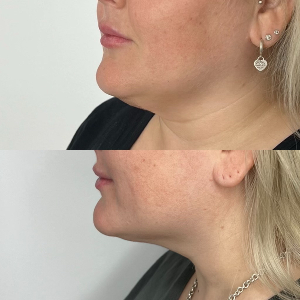 Chin Fat Dissolver at PuraGlow Aesthetic in Oklahoma City, OK