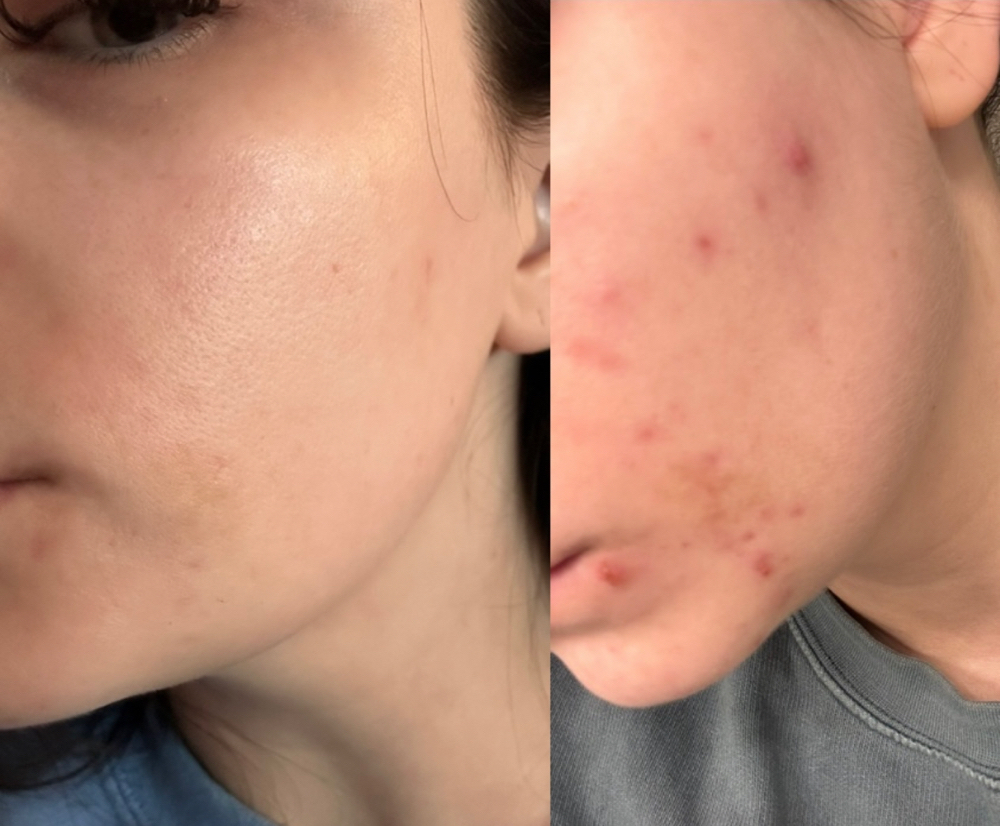 New Client Treatment (ACNE CLIENTS)