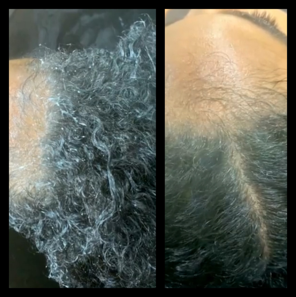 Scalp Services