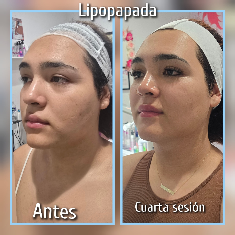 Lipo papada Con Enzimas RX